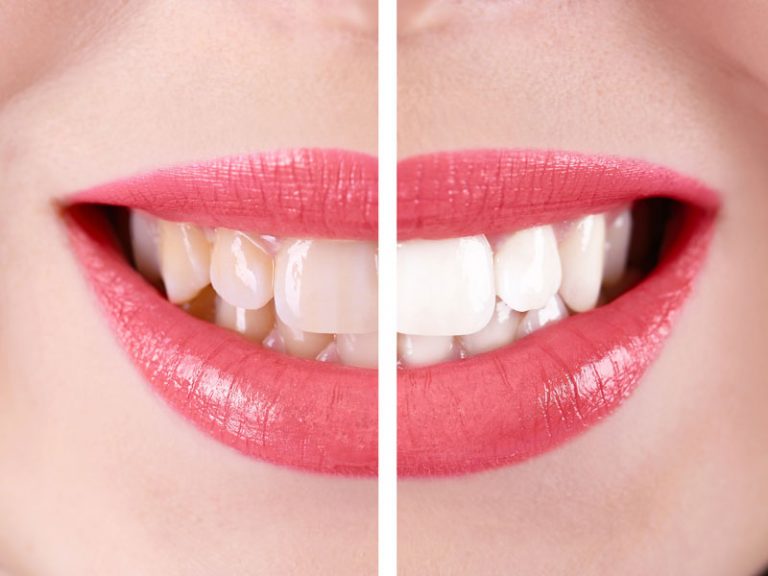 Why you should opt for a teeth whitening procedure